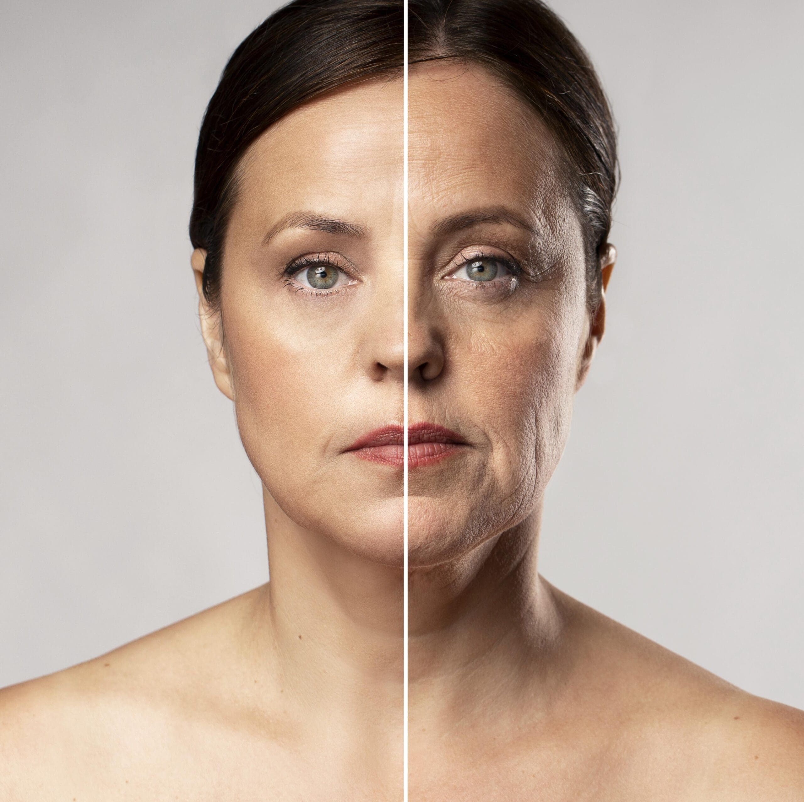 Antes y después de aplicar botox en bogotá